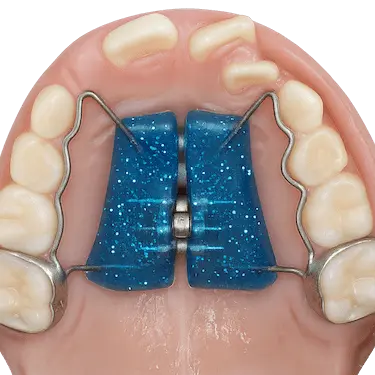 Disyuntor Haas con apoyo acrílico para ensanchar el paladar en tratamientos infantiles