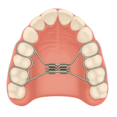 Disyuntor Hyrax visto desde el paladar para ensanchar el maxilar superior en niños