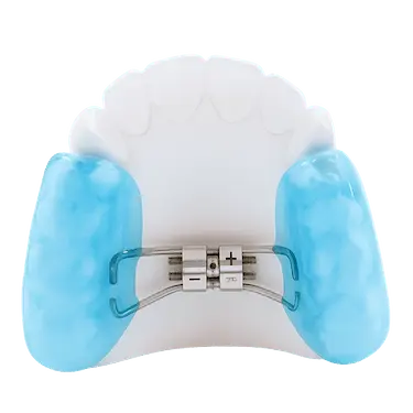 Disyuntor McNamara con bloques acrílicos para expandir el paladar en niños