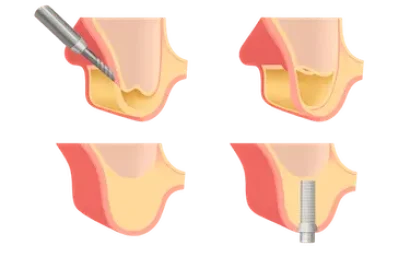 Ilustración del proceso de elevación de seno maxilar para implantes dentales