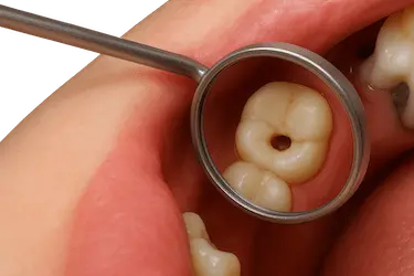 Diente fracturado con cavidad visible en la raíz que requiere tratamiento de endodoncia