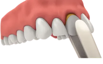 Representación de una extracción dental previa a la colocación de implantes en Murcia