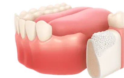 Expansión ósea dental en Madrid para aumentar el hueso y permitir implantes dentales