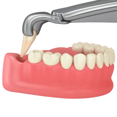 Ilustración 3D de una extracción cordal simple del tercer molar con fórceps