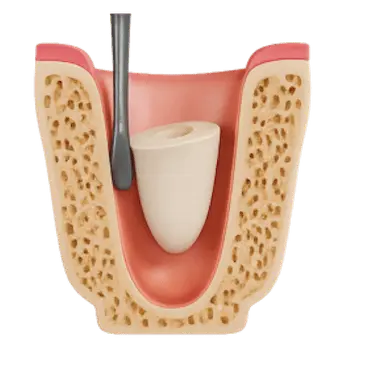 Ilustración 3D del proceso de extracción de un resto radicular dental con instrumento quirúrgico