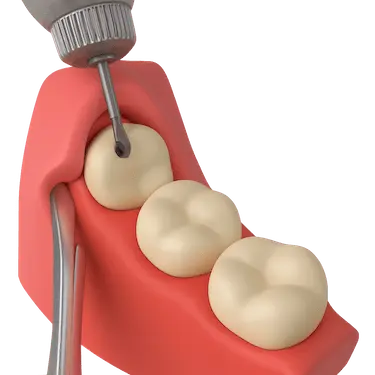 Extracción dental compleja en representación 3D con instrumental quirúrgico y muela visible