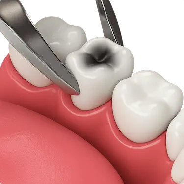 Ilustración 3D de una extracción dental simple de una muela dañada con caries profunda