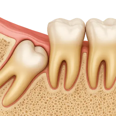 Ilustración 3D de una muela del juicio incluida bajo la encía presionando al segundo molar