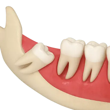 Ilustración 3D de una muela del juicio semi incluida en la mandíbula antes de su extracción dental