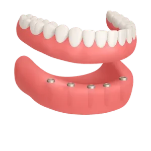 Prótesis dental híbrida completa inferior sobre implantes dentales
