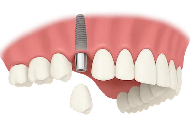 Implante dental anterior con corona para sustituir un diente ausente en clínica de Murcia