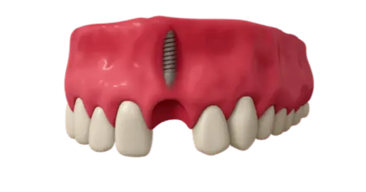 Imagen de un implante dental unitario en la arcada superior en la Clínica Dental del Dr. Ferrer en Madrid