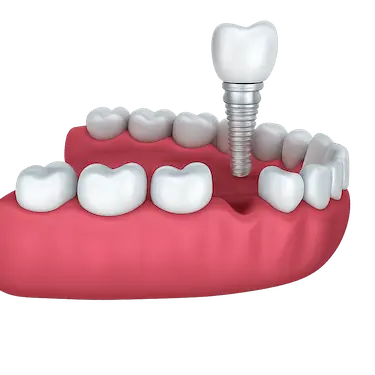 Solución con implante dental unitario para reemplazar una pieza perdida