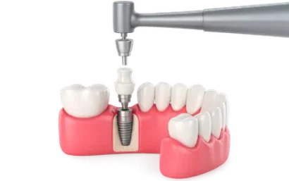 Implantes de carga inmediata con colocación del prótesis provisional en una sola intervención