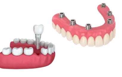 implantes dentales Madrid Dr. Ferrer