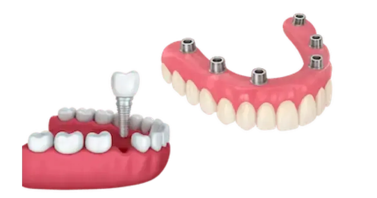 Tratamientos implantes dentales Madrid Dr. Ferrer