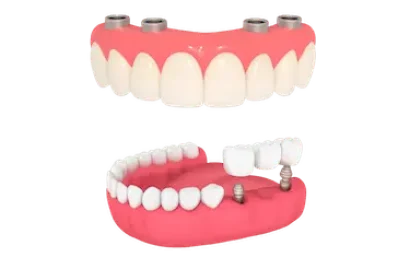 Implantes dentales en Murcia con soluciones para una, varias o todas las piezas