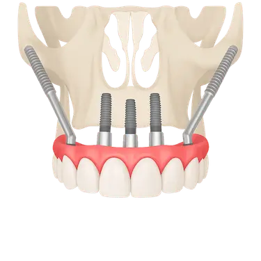 imagen frontal de implantes cigomáticos colocados en maxilar superior