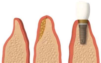 Injerto de hueso previo a implantes dentales en Murcia, ilustración en tres fases