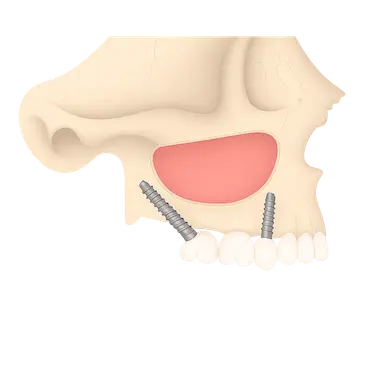 Implantes pterigoideos colocados en el maxilar posterior para rehabilitación dental avanzada