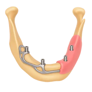 Implantes dentales subperiósticos sobre la mandíbula en casos de pérdida ósea severa