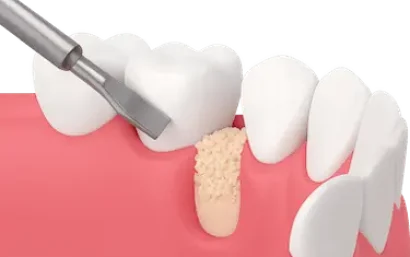 injerto de hueso dental previo para colocar implantes dentales