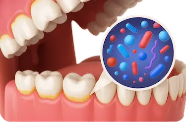 Mala higiene dental con placa bacteriana acumulada, causa frecuente de abscesos dentales
