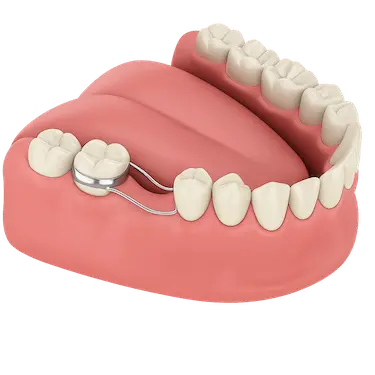 Mantenedor de espacio dental en modelo de boca infantil para conservar el hueco del diente