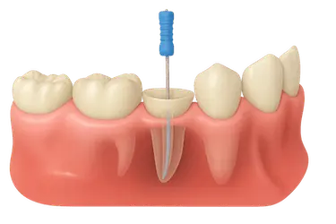 Ilustración 3D del proceso de endodoncia mostrando el instrumento en el conducto dental