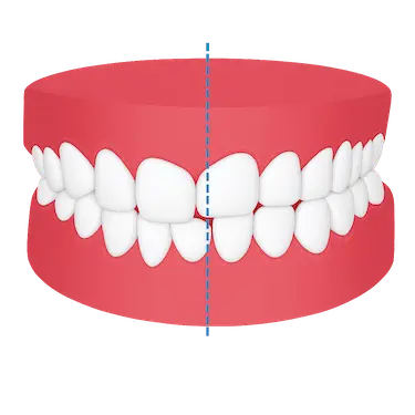 Modelo dental infantil mostrando una mordida cruzada con la línea media desviada