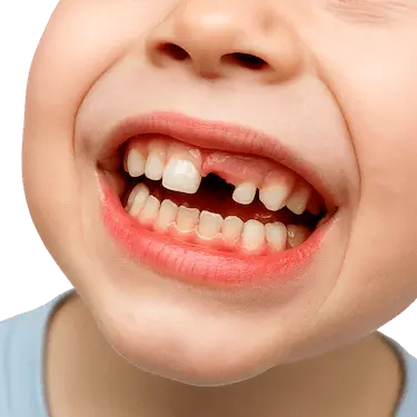 Dientes temporales y definitivos en boca infantil mostrando la fase de dentición mixta