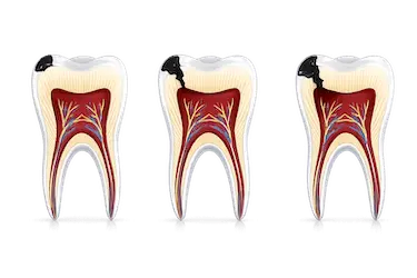 tratamiento de odontología conservadora para salvar un diente y preservar su estructura natural