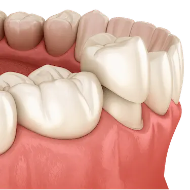 Tratamiento de odontología conservadora en Madrid para preservar dientes sanos