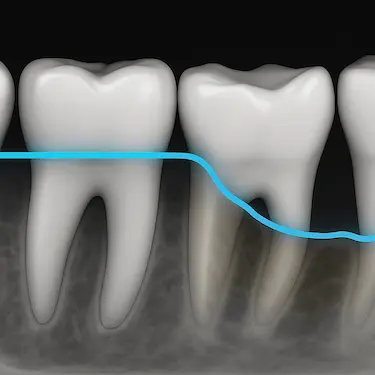 Pérdida de hueso dental en radiografía, periodontitis tratable con curetaje en Madrid
