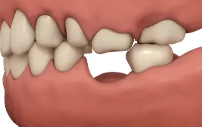 Espacio sin diente entre dos piezas dentales que puede resolverse con un implante unitario