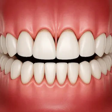 que es la periodoncia o enfermedad de las encías