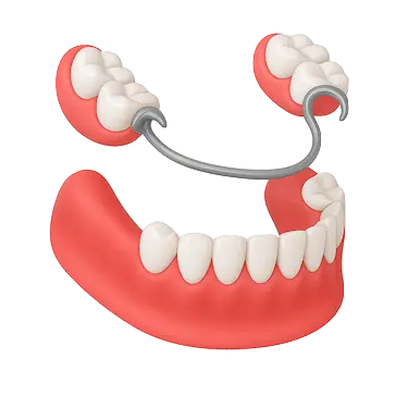 Prótesis dental parcial removible sin implantes con ganchos metálicos en el maxilar inferior