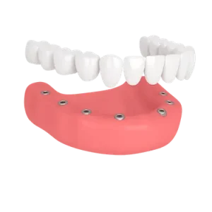 Prótesis fija completa inferior sobre implantes dentales con coronas de porcelana