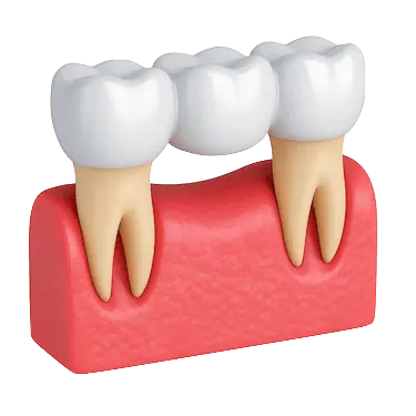 puente dental fijo sobre dientes naturales con tres coronas