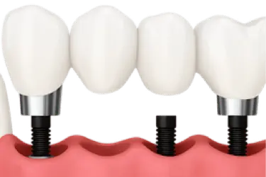 Puente dental sobre implantes en encía inferior para sustituir varias piezas con el Dr. Ferrer