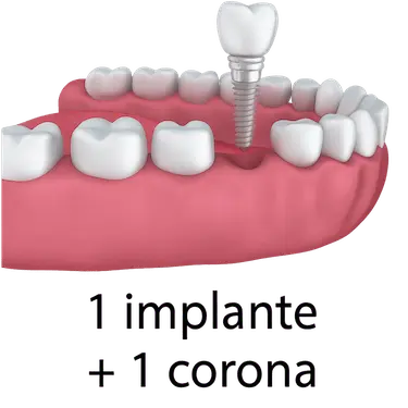 implante dental unitario con corona, mostrando un tornillo de titanio