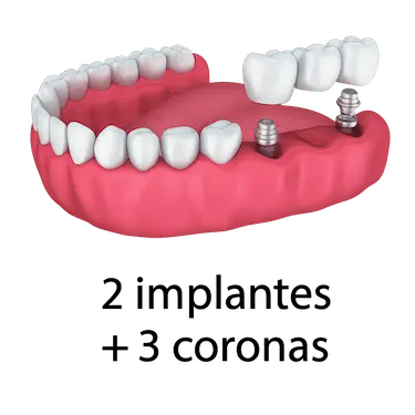Puente dental sobre implantes con dos pilares y tres coronas en la arcada inferior