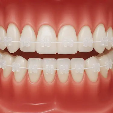 Brackets de zafiro transparentes con arco blanco en tratamiento de ortodoncia estética