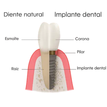 Comparación entre un diente natural y un implante para explicar qué son los implantes dentales