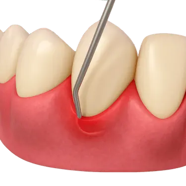 Raspado dental para eliminar sarro y tratar la periodontitis en Madrid