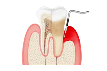 Ilustración 3D de raspado y alisado radicular en Madrid para eliminar sarro subgingival