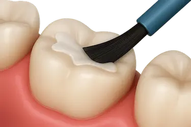 Odontólogo aplicando selladores dentales en muelas para prevenir caries y proteger fisuras