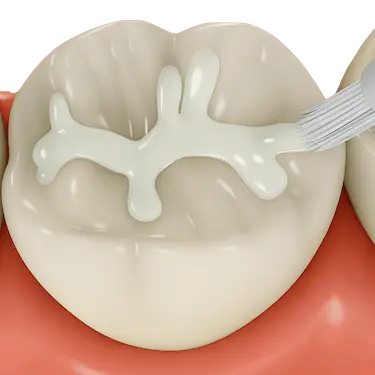 Aplicación de sellador dental sobre una muela para prevenir caries en fosas y fisuras