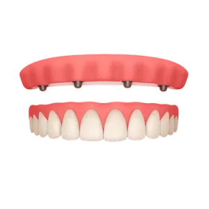 Prótesis completa removible tipo sobredentadura superior sobre implantes dentales