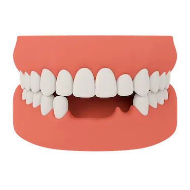 Ausencia de varias piezas dentales rehabilitada con puentes fijos sobre implantes dentales